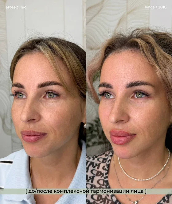 Комплексный проткоол: Контурная пластика губ, скул и подбородка 