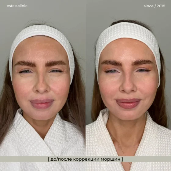 Ботулинотерапия