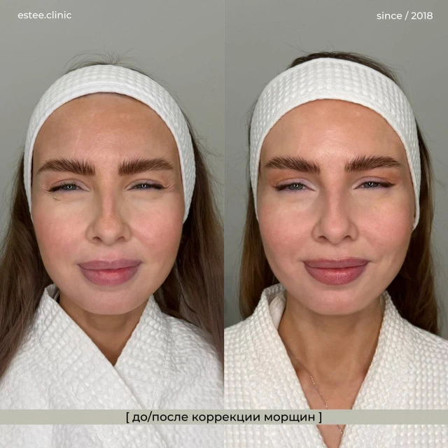 Ботулинотерапия
