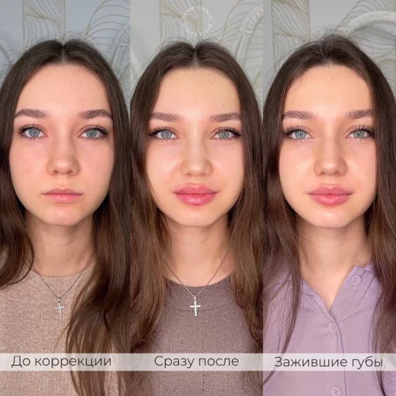 Контурная пластика губ