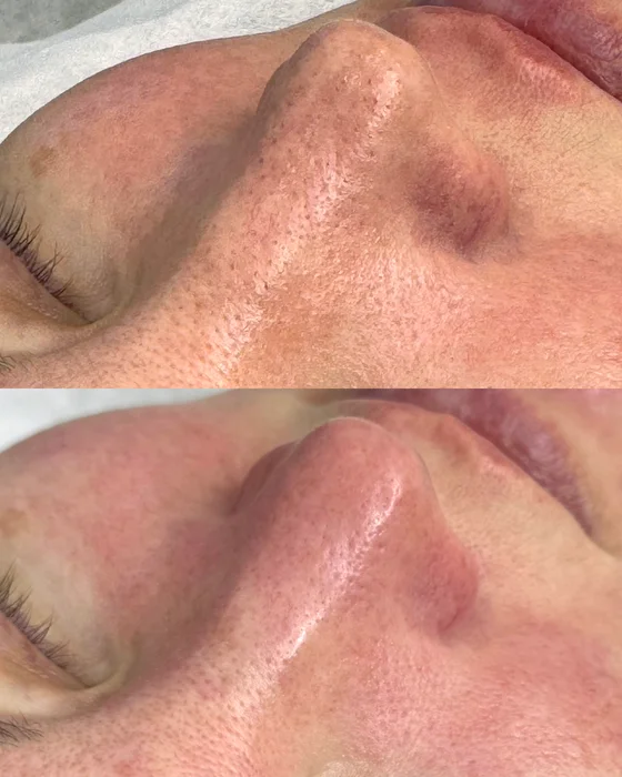 Чистка лица HydraFacial