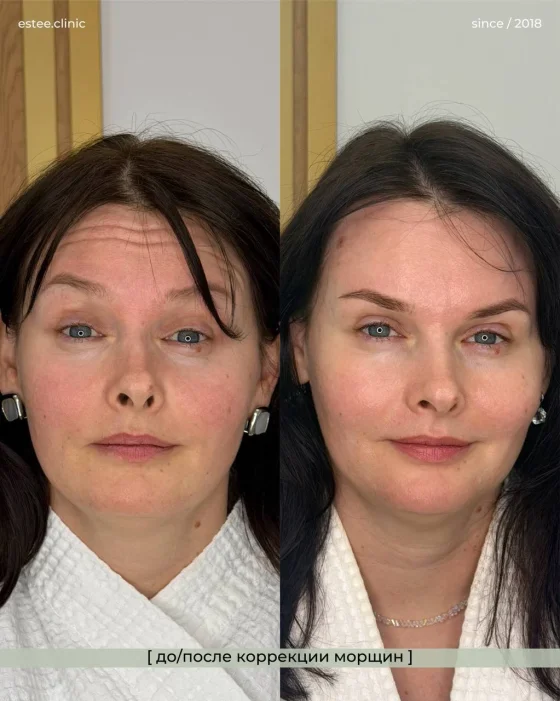 Ботулинотерапия