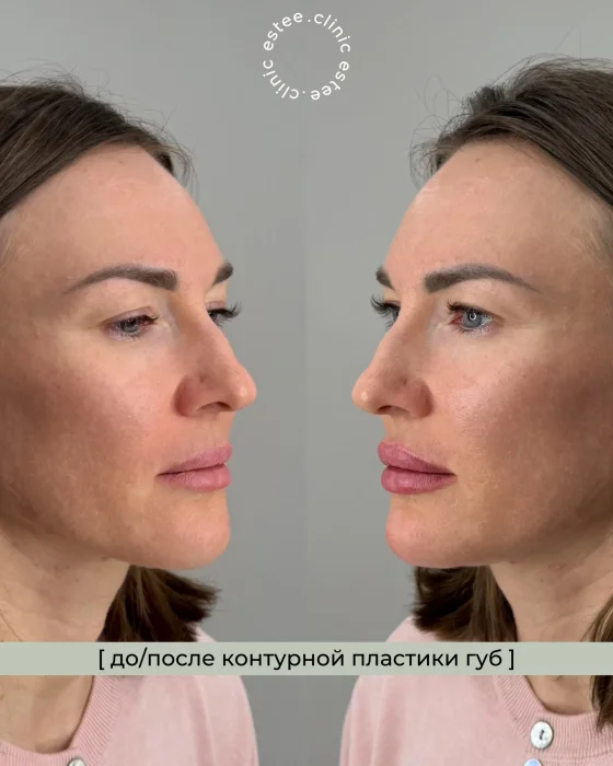 Контурная пластика губ