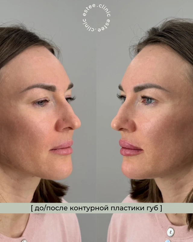 Контурная пластика губ