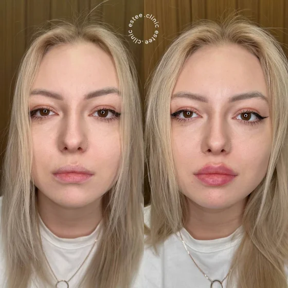 Контурная пластика губ