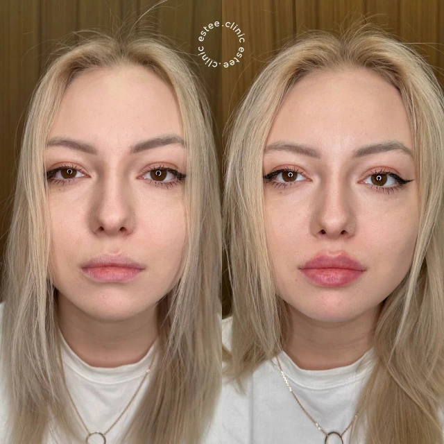 Контурная пластика губ