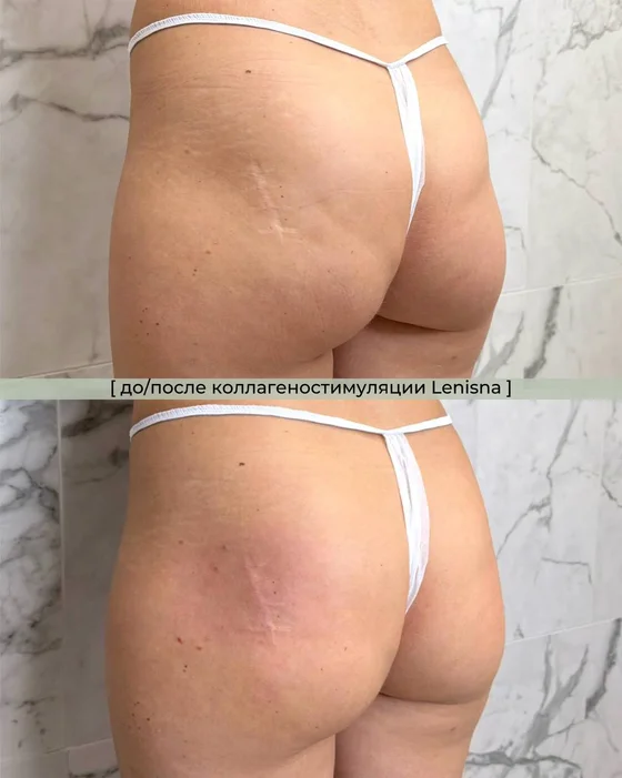 Коллагеностимуляция