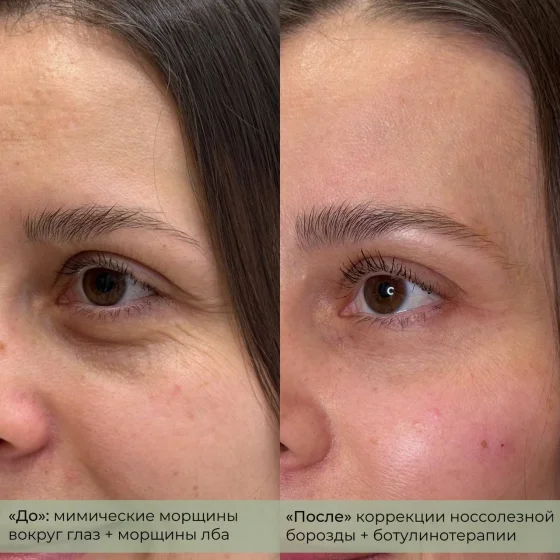 Коррекция носослезной борозды