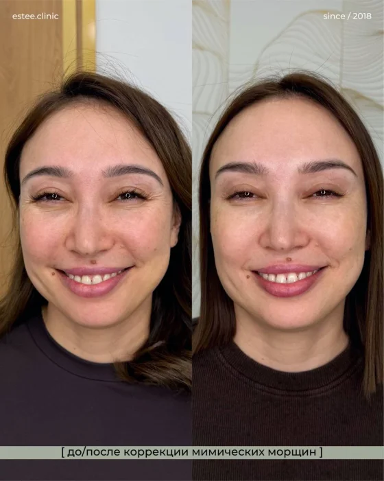 Ботулинотерапия