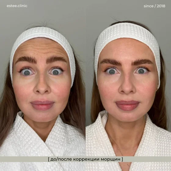 Ботулинотерапия