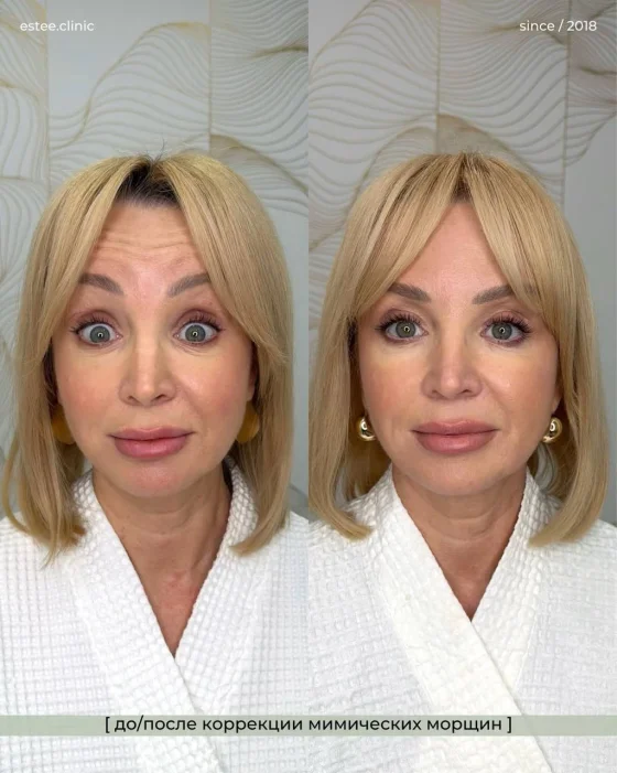 Ботулинотерапия