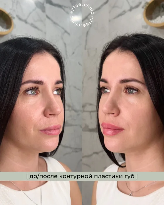 Контурная пластика губ