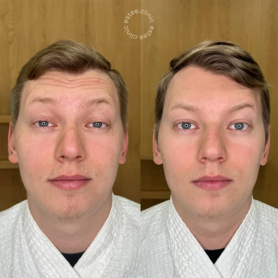 Ботулинотерапия