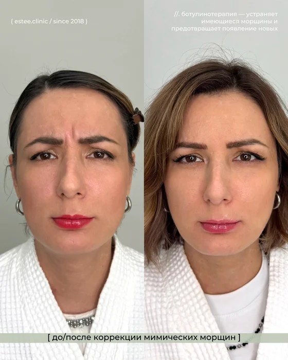 Ботулинотерапия