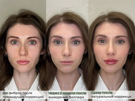 Коррекция губ после миграции филлеров