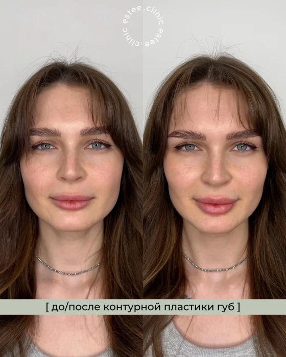 Контурная пластика губ 