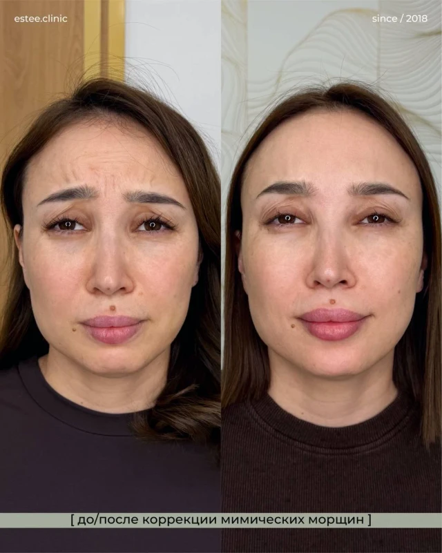 Ботулинотерапия