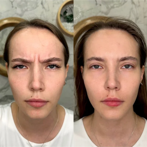 Ботулинотерапия
