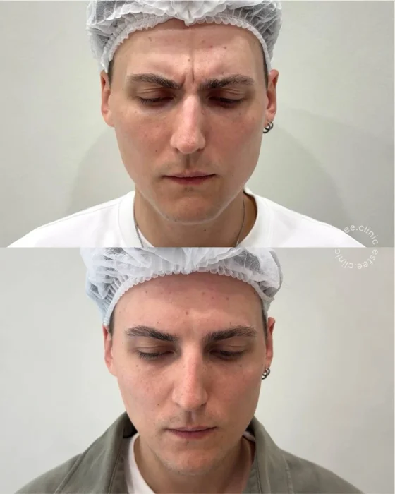 Ботулинотерапия