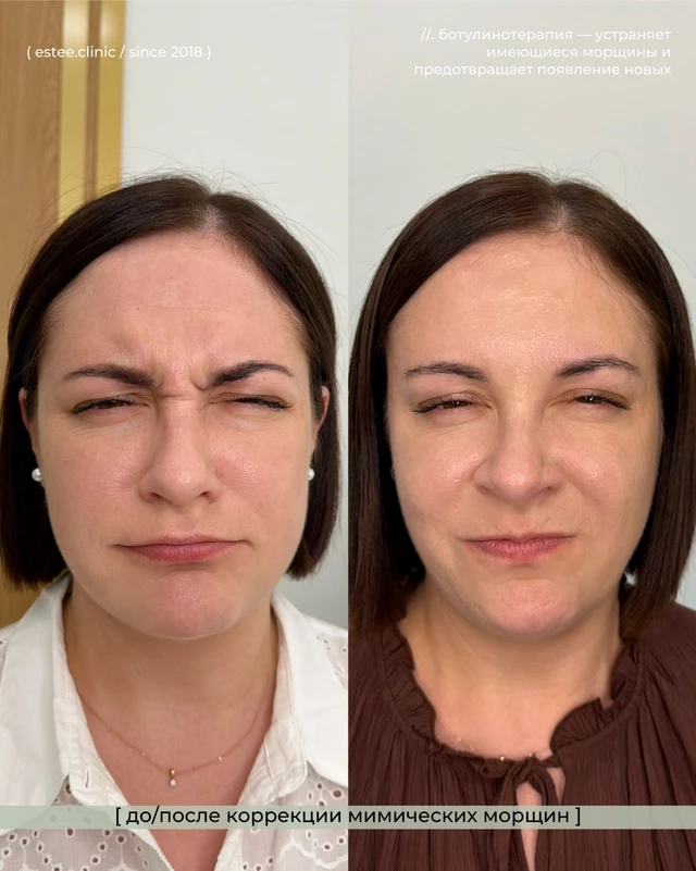 Ботулинотерапия