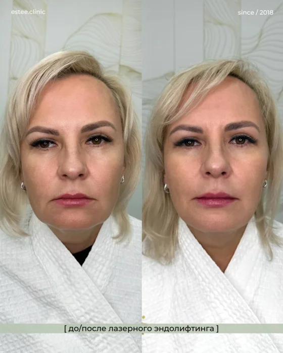 Эндолифтинг