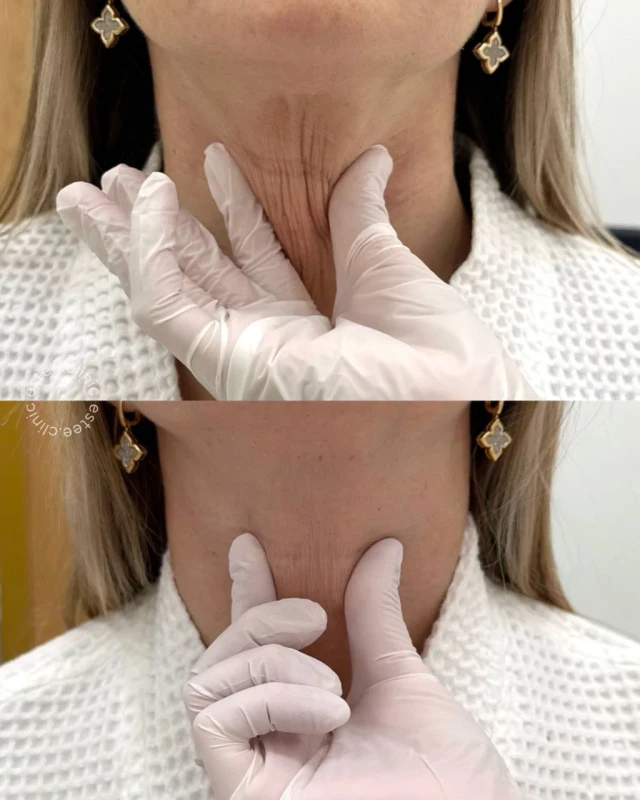 Коллагеностимуляция Sculptra