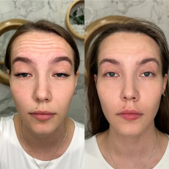 Ботулинотерапия