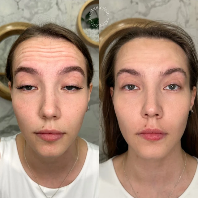 Ботулинотерапия