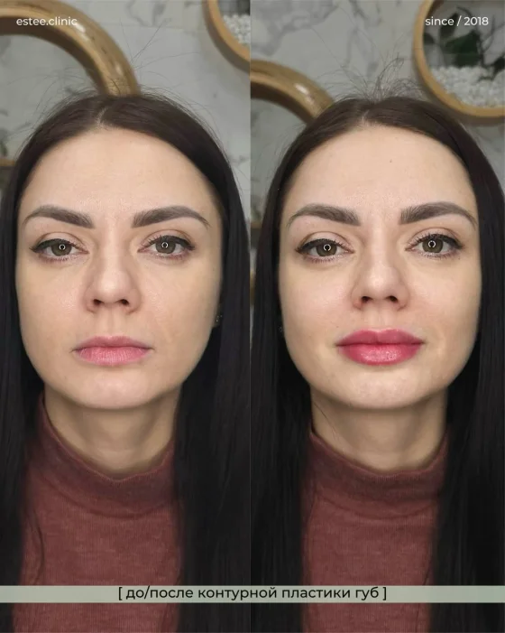 Контурная пластика губ